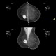 Breast carcinoma, big: MMG - Mammography